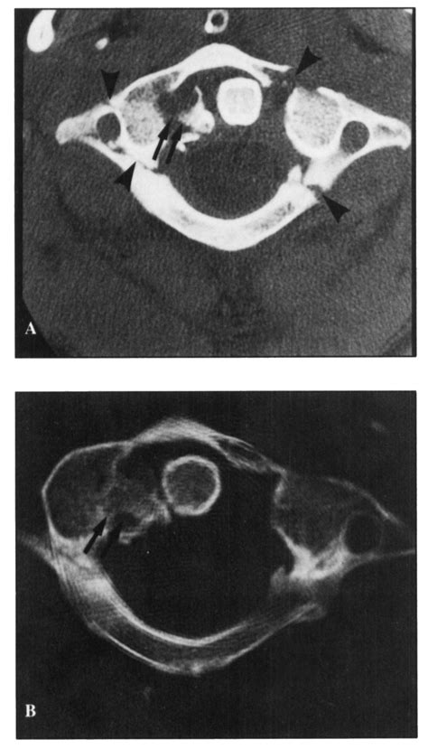 A) CTscan demonstrating a Jefferson fracture (arrow heads demonstrate ...