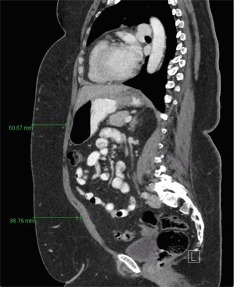 Intestinal Stomas Springerlink