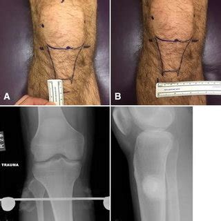 Proximal Tibial Traction Pin Landmarks A The Patella Is Marked Four