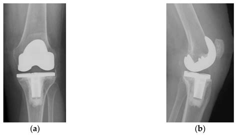 Diagnostics Free Full Text Patellar Resurfacing In Total Knee