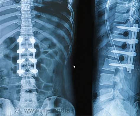 Spinal Fusion Types Risks Complications Prognosis