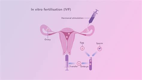 Ivf In Vitro Fertilization Or Test Tube Baby Dr Anindita Singh