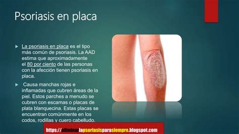 Conoce Los Diferentes Tipos De Psoriasis Que EXISTEN PPT