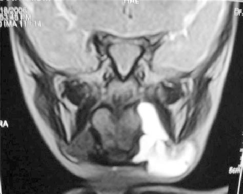 Mri Showing Cystic Lesion On The Left Side In The Sublingual Region