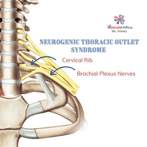 Thoracic Outlet Syndrome Vascular Info