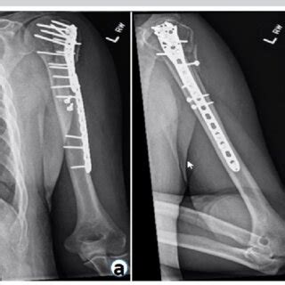 A And B Anteroposterior And Lateral Radiographs Demonstrating A