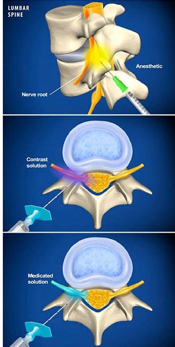 Lumbar Transforaminal Epidural Steroid Injection - The Southeastern Spine Institute