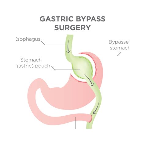 Gastric Bypass Surgery