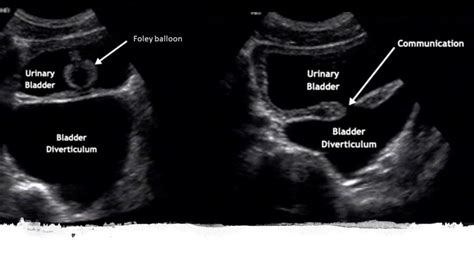 Urinary Bladder Diverticula The Mickey Mouse Sign Nephropocus