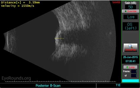 Atlas Entry Idiopathic Sclerochoroidal Calcification