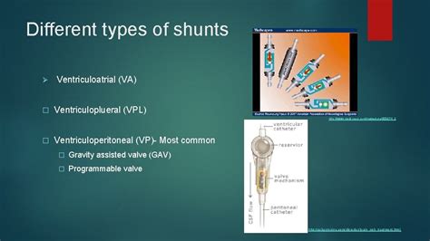 Hydrocephalus shunts BY ALEX GRAY BME 281 What