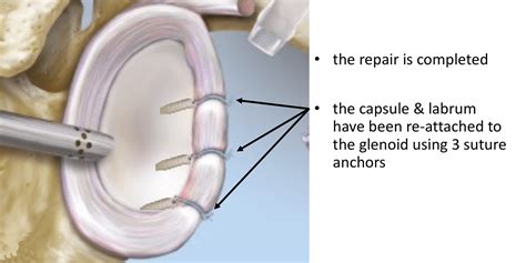 Fig 27 Bankart Completed Repair Cambridge Shoulder