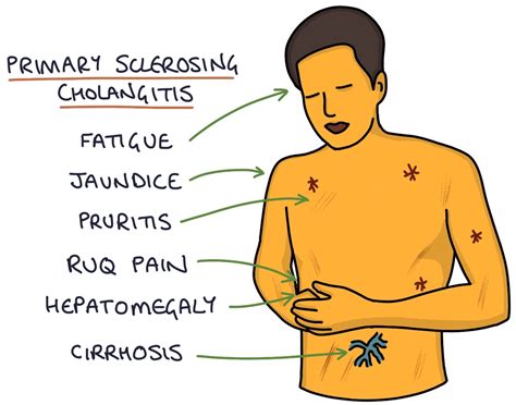 Primary Sclerosing Cholangitis Zero To Finals