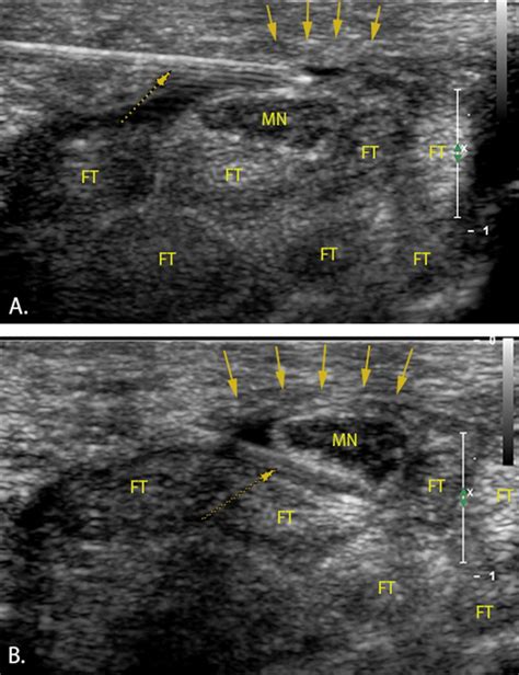 Ultrasound Guided Hydrodissection Decreases Gliding Resistance Of The Median Nerve Within The