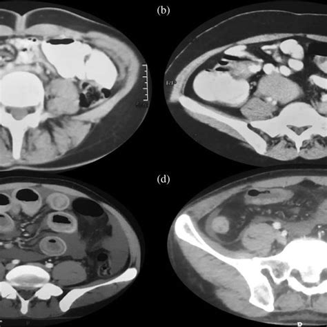 Colonoscopic Images Showing A Circumferential Ulceration In The Cecum Download Scientific