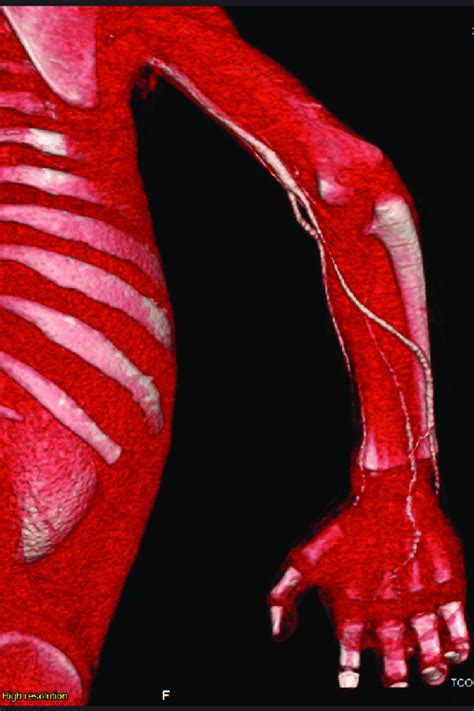 D Reconstruction Of Ct Angiography Revealing Patent Vessels Of The