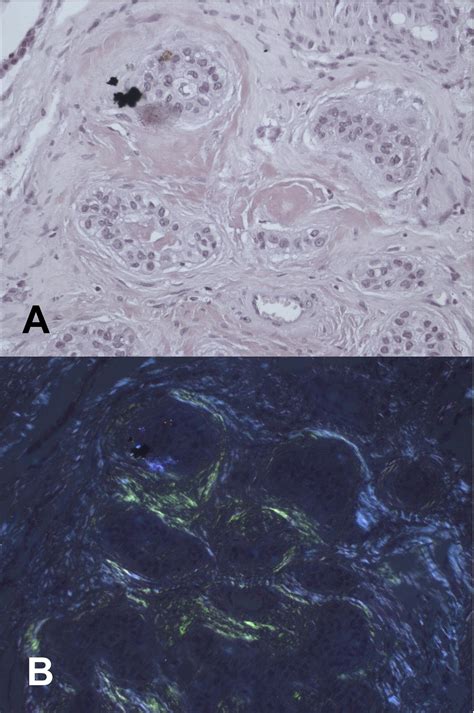 Peripheral Clear Cell Variant Of Calcifying Epithelial Odontogenic