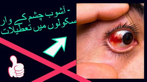 Eye Infection Ashob E Chashm Conjunctivitis Cases On The Rise How