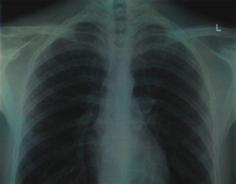X-Ray Imaging Technique Allows Scientists to See Cystic Fibrosis ...