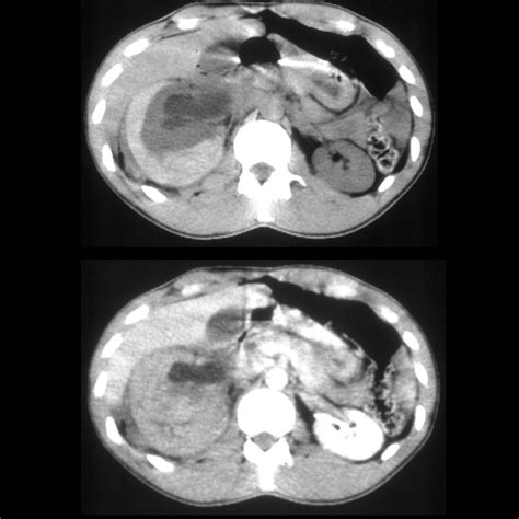 Pediatric Ureteropelvic Junction Obstruction | Pediatric Radiology ...