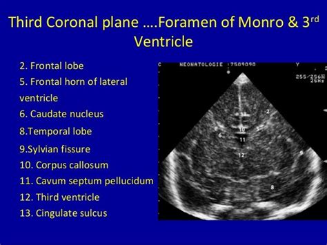 Cranial Ultrasound of neonate