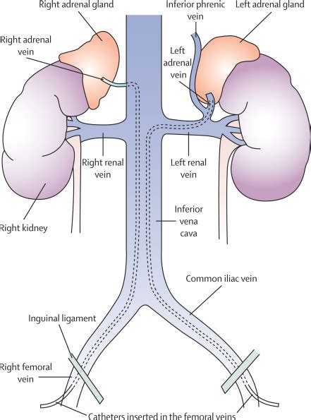 Adrenal Vein Sampling In Primary Aldosteronism Towards A Standardised