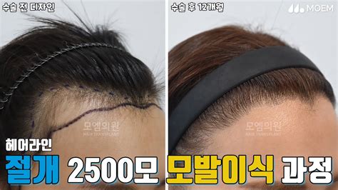 여성 헤어라인교정으로 넓은 M자 이마 줄이기 절개 2500모 후기 ️｜전지훈 원장｜모엠의원moem Youtube