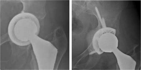 Preoperative Left And Postoperative Right Radiograph For A Download Scientific Diagram