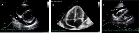 Frontiers Echocardiographic Evaluation Of Pericardial Effusion And