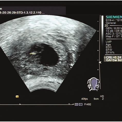 Ultrasound Scan Shows A Gestational Sac In The Right Ovary Download Scientific Diagram