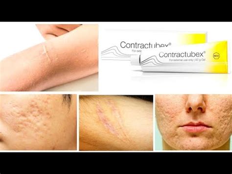 Contractubex Gel For Acne Scars Youtube