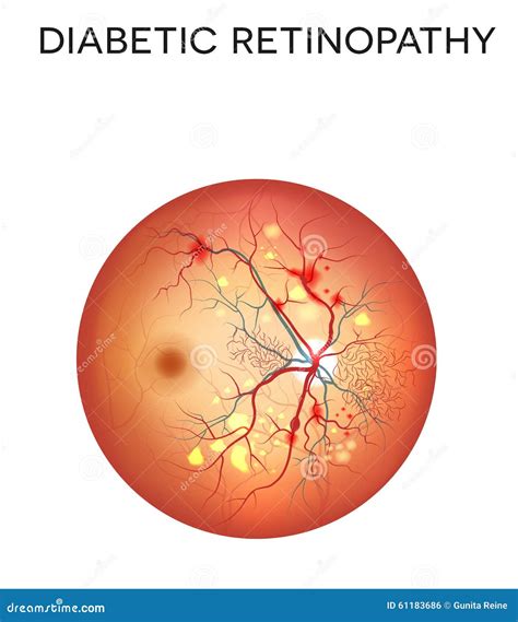 Retinopatia Diabetica Illustrazione Vettoriale Illustrazione Di Anatomico 61183686