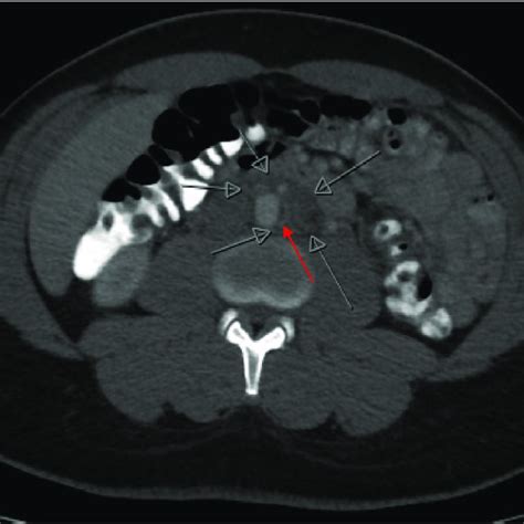 Axial View Of Ct Abdomen And Pelvis With Oral And Intravenous Contrast Download Scientific