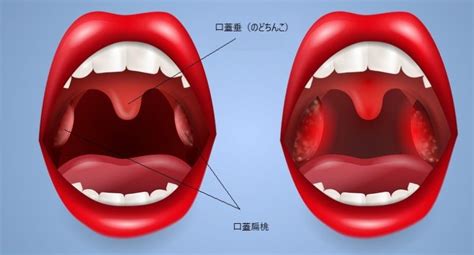 口蓋扁桃＆口蓋垂摘出術 「あるぷす薬局・あしたば薬局」（浜松市ベストシステムグループ）