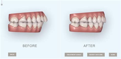 thoughts  treatment simulation   orthodontist  invisalign