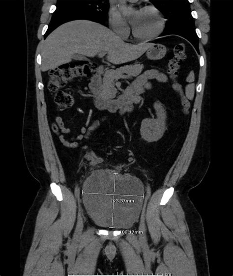 Case Report Prostatic Cystadenoma A Rare Case Report And Literature Review American