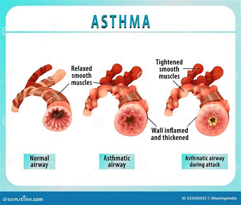 Bronchial Asthma Infographics Vector Illustration | CartoonDealer.com ...