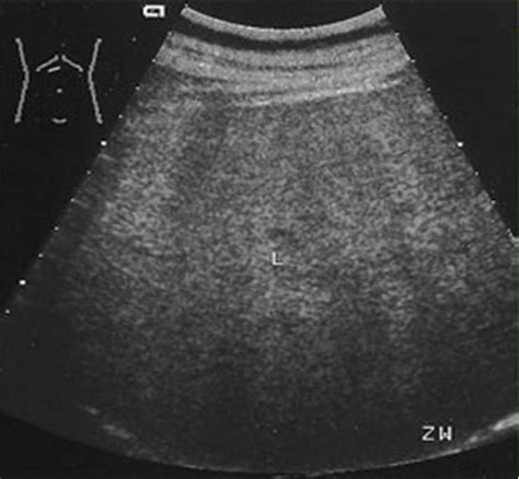 Wk 2 Liver Pathology Chronic Hepatitis Abd 200 Mod 3 Ultrasound