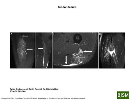 Tendon Failure Tendon Failure A Coronal Fat Suppressed Image Of A