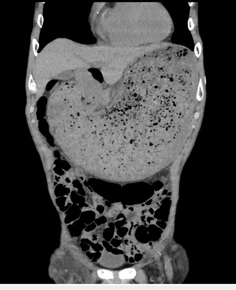 Plain Abdominal Computed Tomography Shows Gastric Distension And Download Scientific Diagram