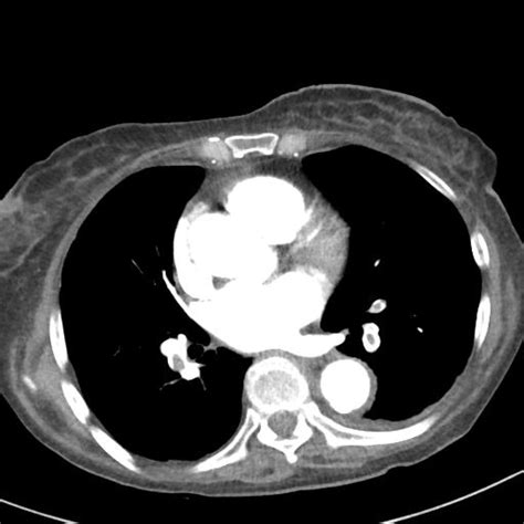 Pulmonary Emboli With Right Heart Strain Image