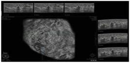 Scielo Brasil Comparison Of Automated Breast Ultrasound And Hand