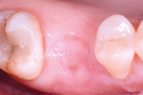 Posterior Socket Preservation Using Maxgraft And Permamem Dr C