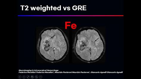 T2 Weighted Image의 임상적인 특징 Mri 자기공명영상 의료영상 방사선 의료기기 의공학 Youtube