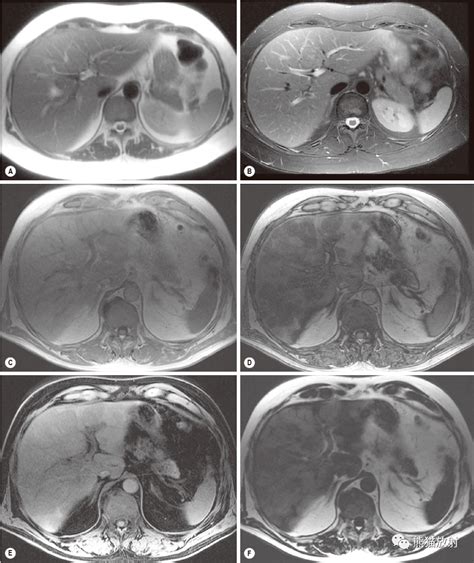 格艾选读丨肝脏影像检查技术CT MRI 对比