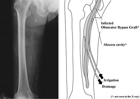 Percutaneous Continuous Irrigation And Drainage For Infected Obturator Bypass Graft Annals Of