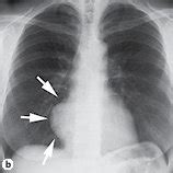 Change in right atrium enlargement on chest X-ray. a Three years before ...