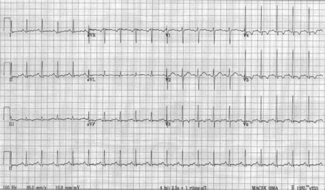 Ecg On Admission Showing Sinus Tachycardia And Negative Twaves In