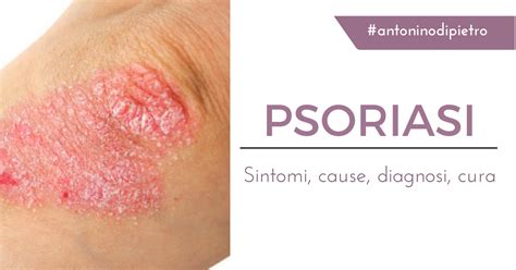 Psoriasi Sintomi Cause Diagnosi Cura Prof Antonino Di Pietro