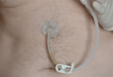 O que é Gastrostomia Endoscópica Percutânea Nutritotal PRO